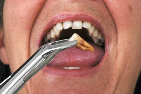 Wisdom Tooth Removal
