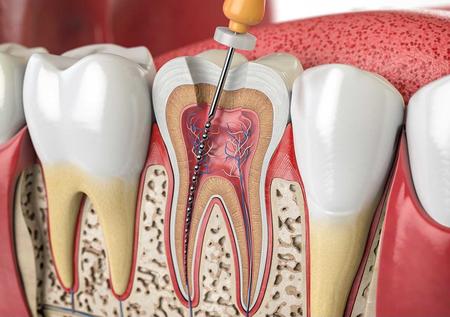Root Canal Treatment