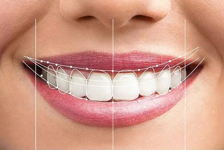 Full mouth rehabilitation bite reconstruction crowns implants