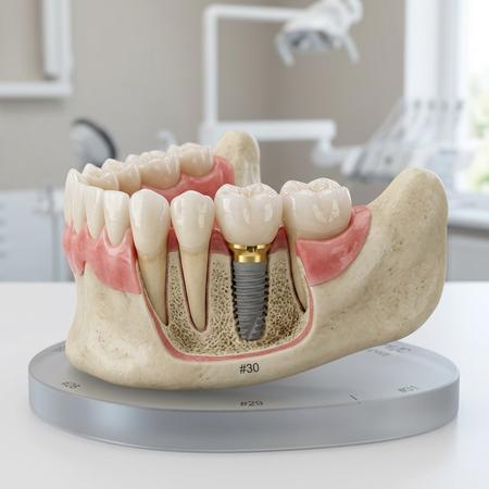Dental Implants